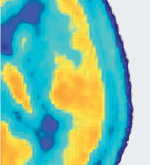 Inflammation and depression