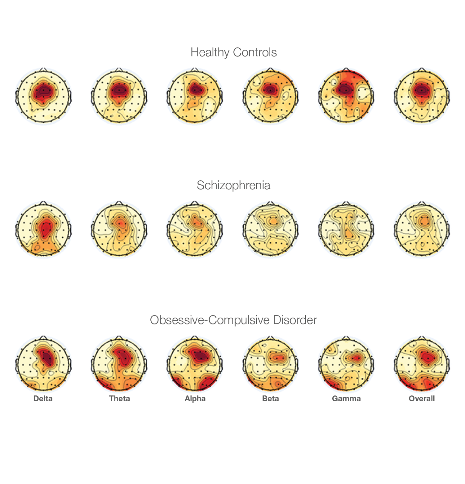 Inhibition in schizophrenia