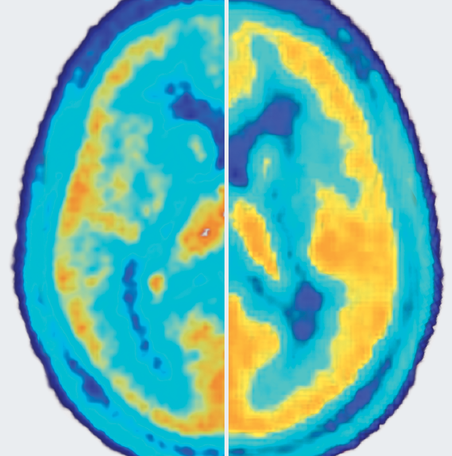 Inflammation and depression